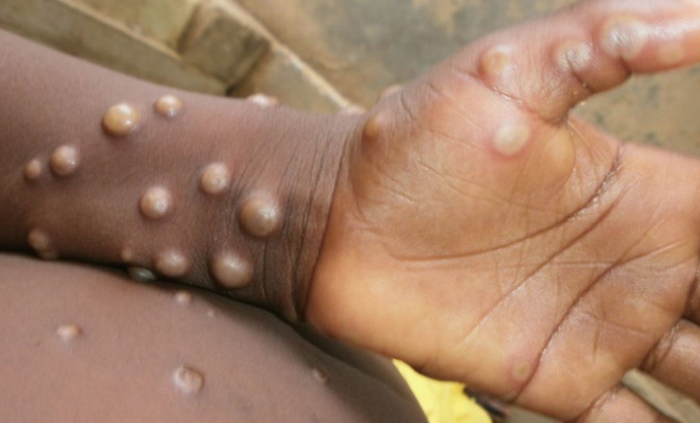 Three Cases Of Monkeypox Recorded In Edo